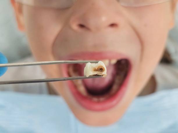 Best Emergency Wisdom Teeth Removal in Olton, TX